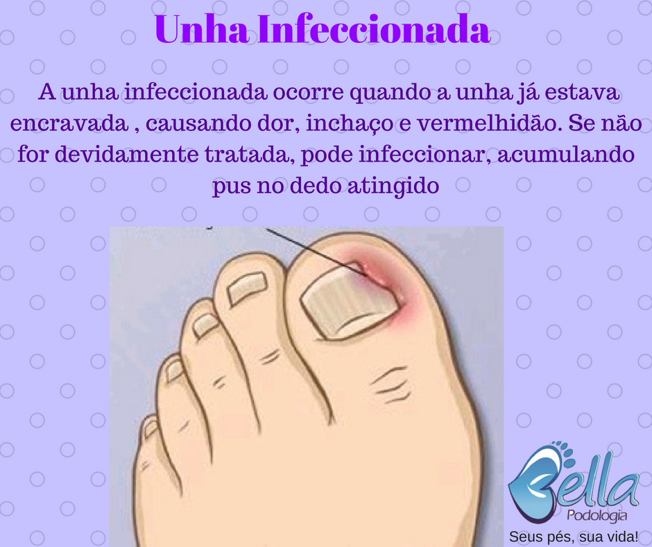 Unha infeccionada :: Bella-podologia